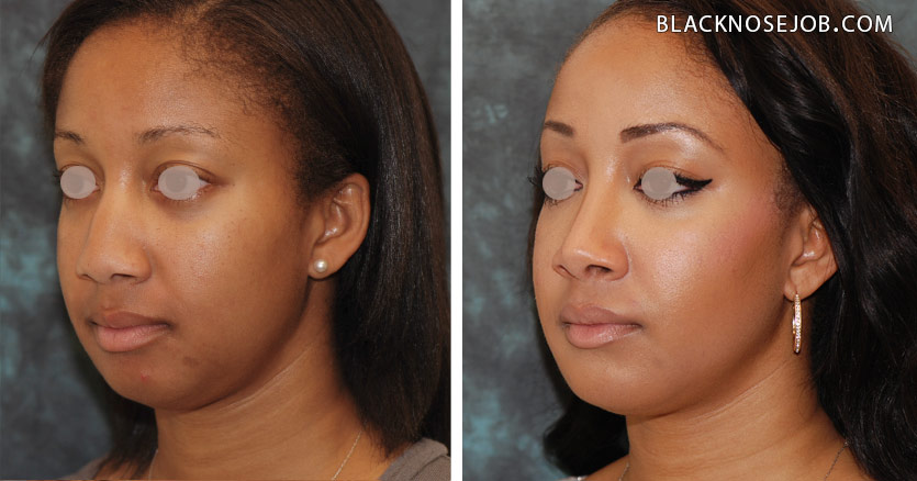 Figure e,f: African American rhinoplasty patient with well balanced facial proportions.
