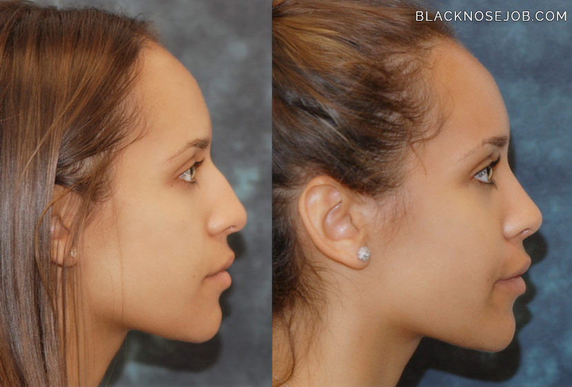 african american rhinoplasty before after