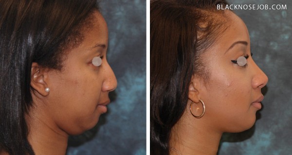 African American Rhinoplasty Specialist In Los Angeles, CA