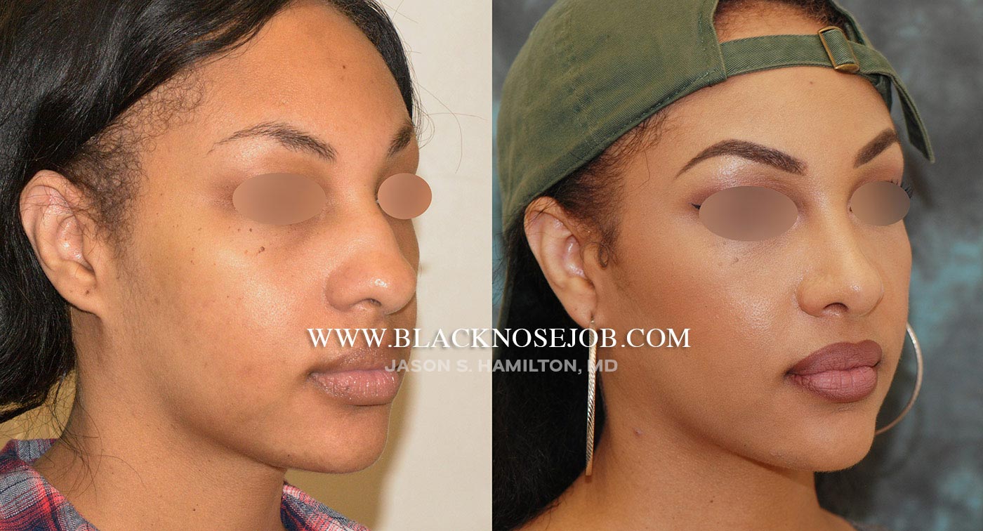 african american nose job before after