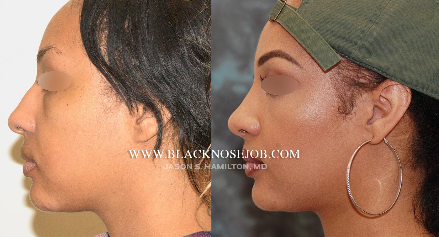 african american rhinoplasty before after