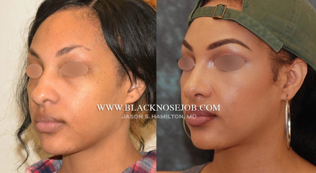black rhinoplasty before after