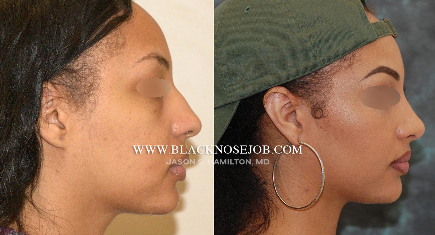 ethnic rhinoplasty before after