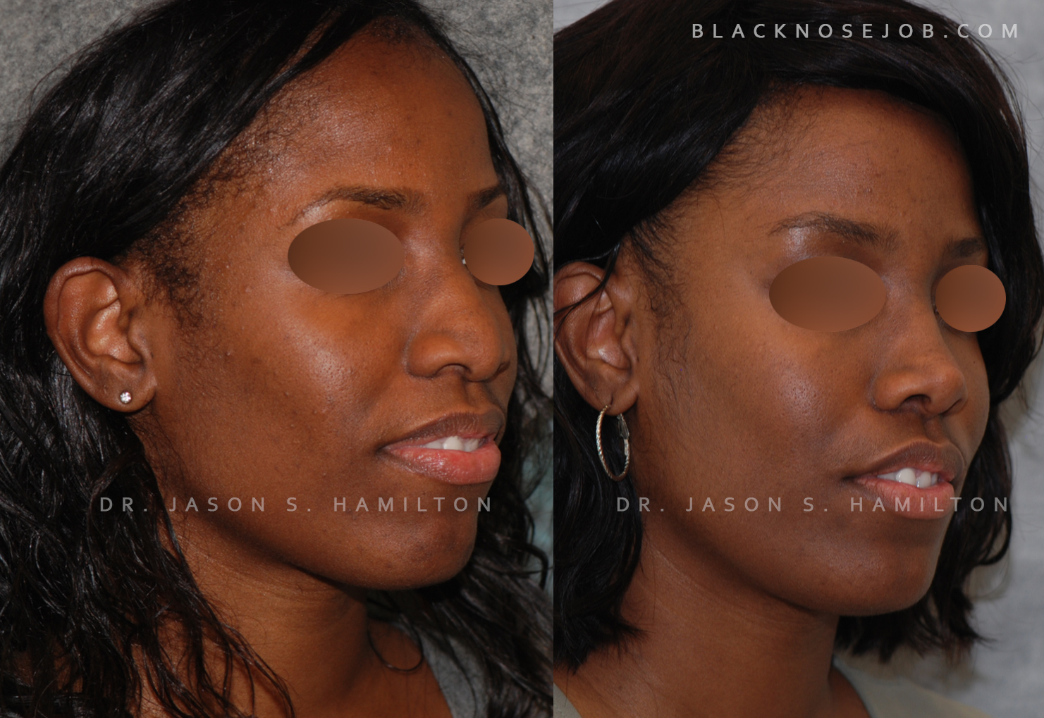 african american rhinoplasty before after
