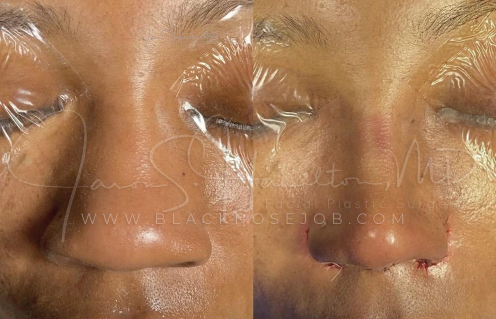 best black nose job rhinoplasty before after photo