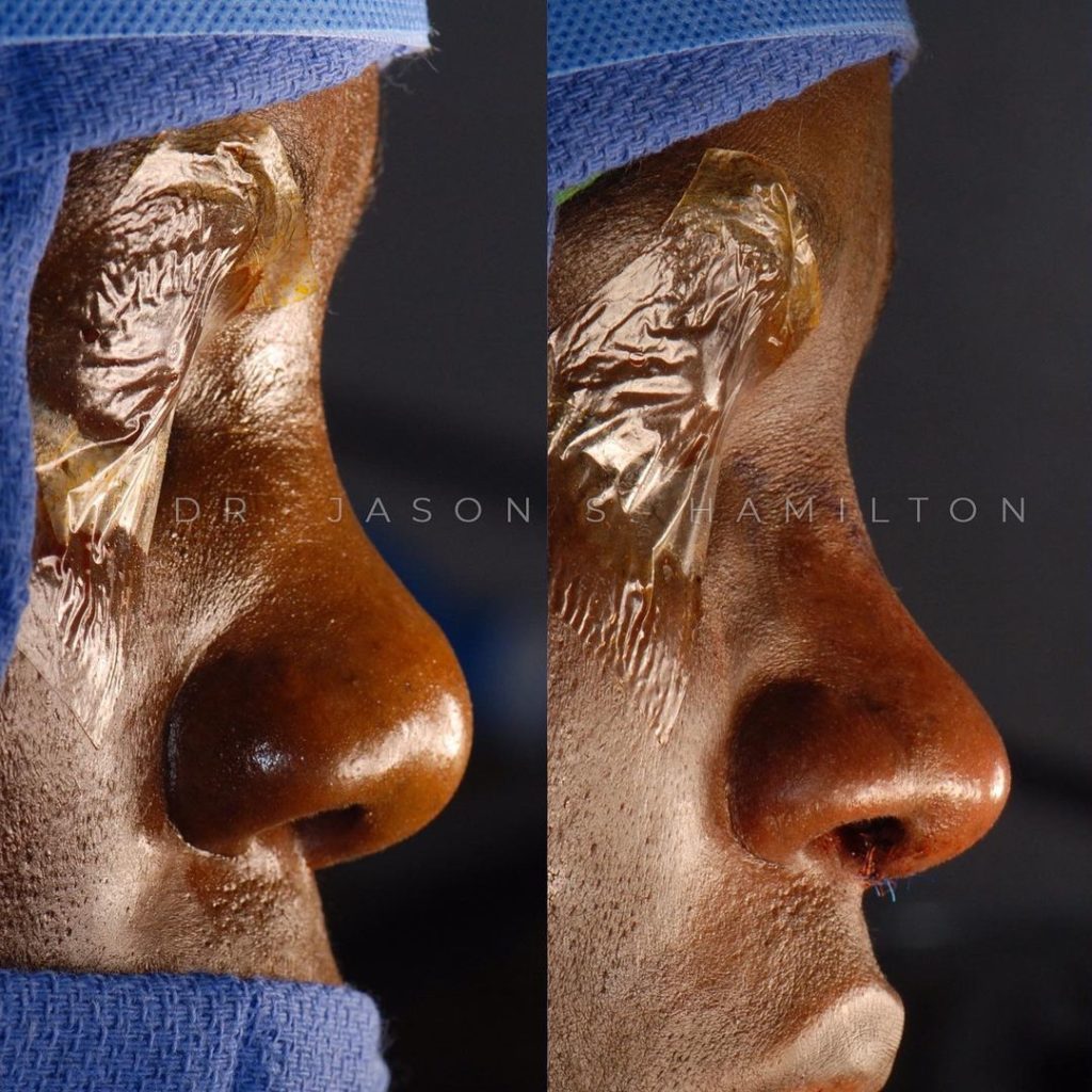 nose surgery african american black
