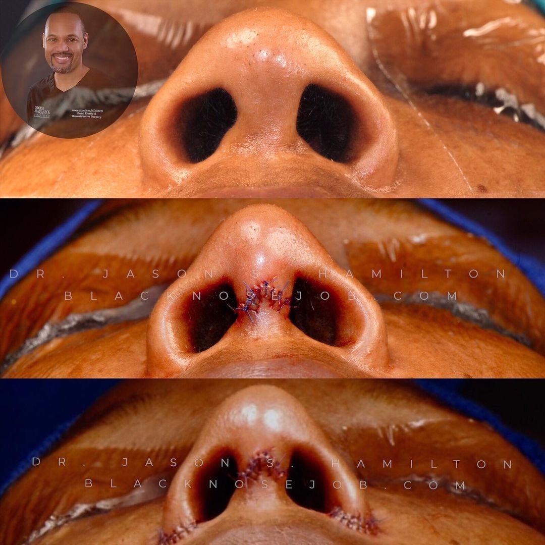 nostril reduction surgery