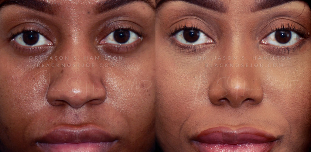 Before After Ethnic Rhinoplasty