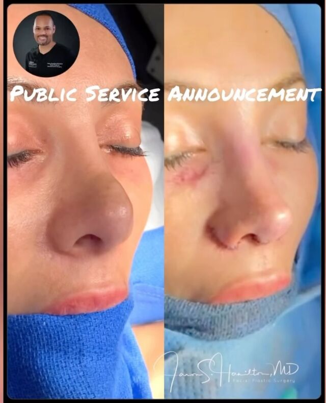 African American Rhinoplasty Los Angeles Black Nose Surgery